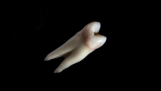 Dental Extractions