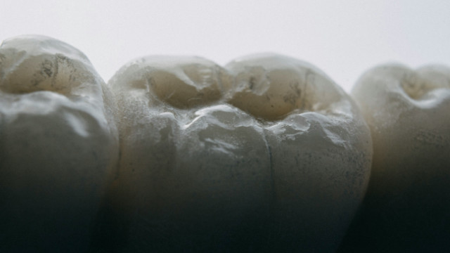 Tooth-Colored Fillings